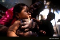 Leprosy patient and child